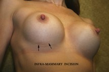 Incisions/Scars for Benign Breast Lump Removal 