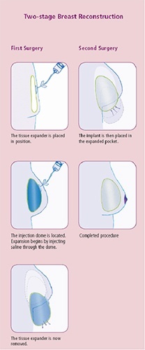 Two Stage Breast Reconstruction