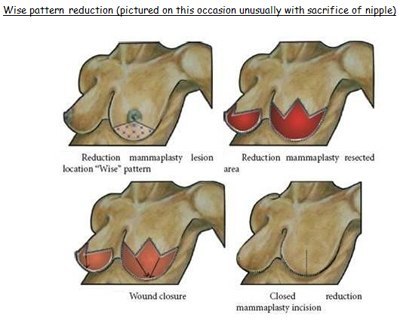 Wise pattern reduction (pictured on this occasion unusually with sacrifice of nipple)