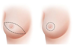 nipple-sparing-mastectomy-featured